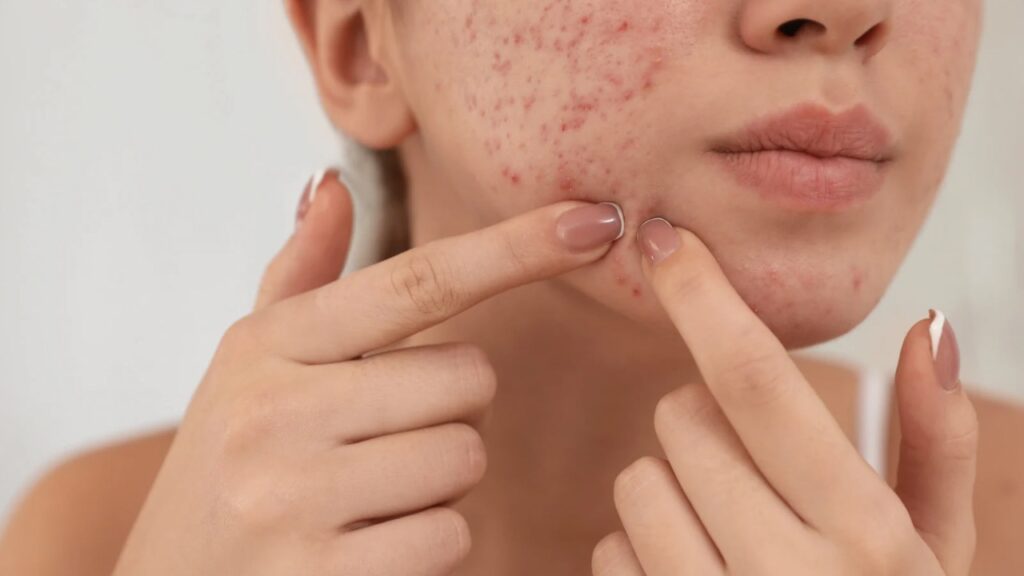 Adult Acne