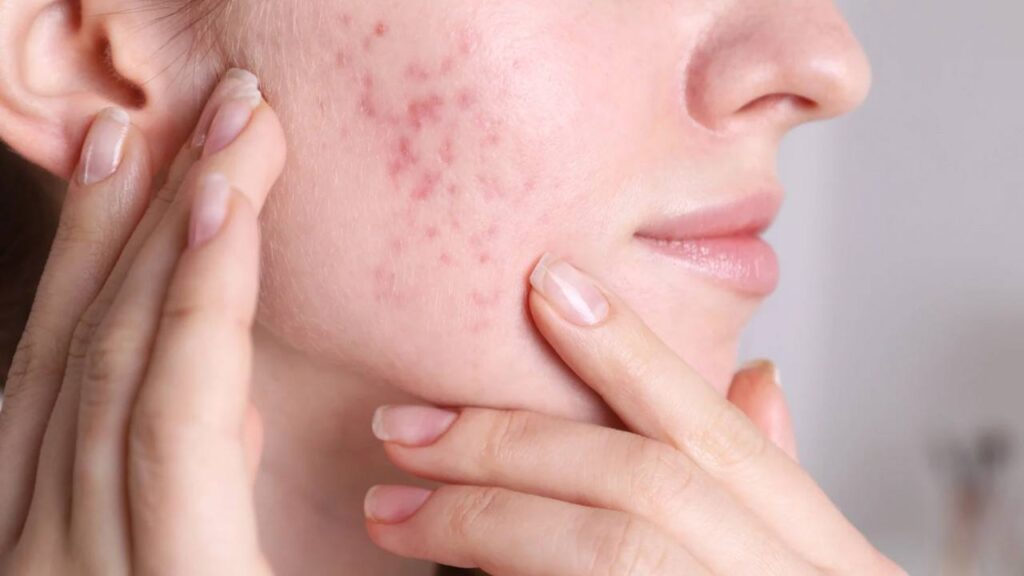 Hormonal Acne