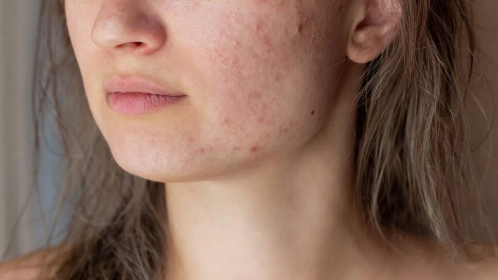 Acne Facials